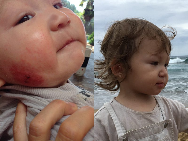 A baby with red spots on its face and the other child has red patches.